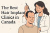 The Best Hair Implant Clinics in Canada bikrisohoj